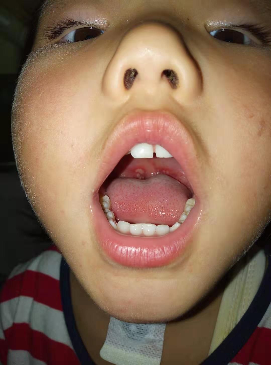 幼儿咽峡炎的症状图片图片