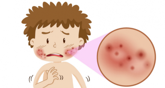 孩子为什么会湿疹反复？如何护理？
